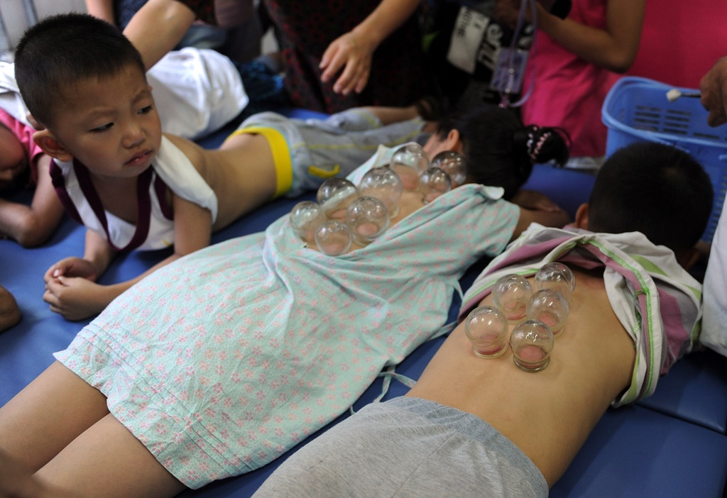 Des enfants chinois en plein de traitement de moxibustion à l'hôpital de médicine chinoise traditionnelle de Hefei, dans la province de l'Anhui à l'est de la Chine, le 18 juillet 2012.