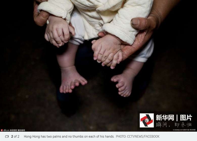 Le petit Hong Hong est né avec une impressionnante polydactylie. Copie d'écran du “Straits Times”, le 5 mai 2016.