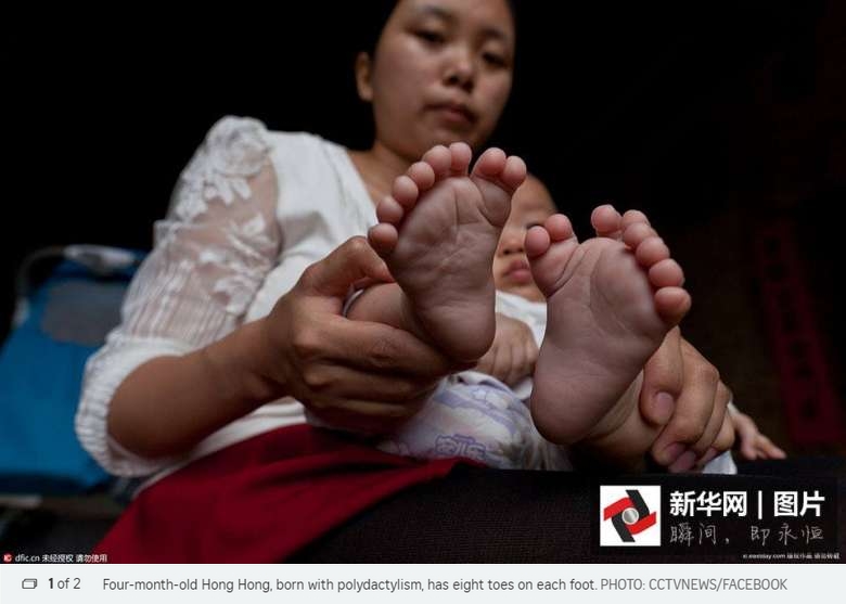 En Chine, un bébé est né avec 31 doigts et orteils. Copie d'écran du "Straits Times", le 5 mai 2016.