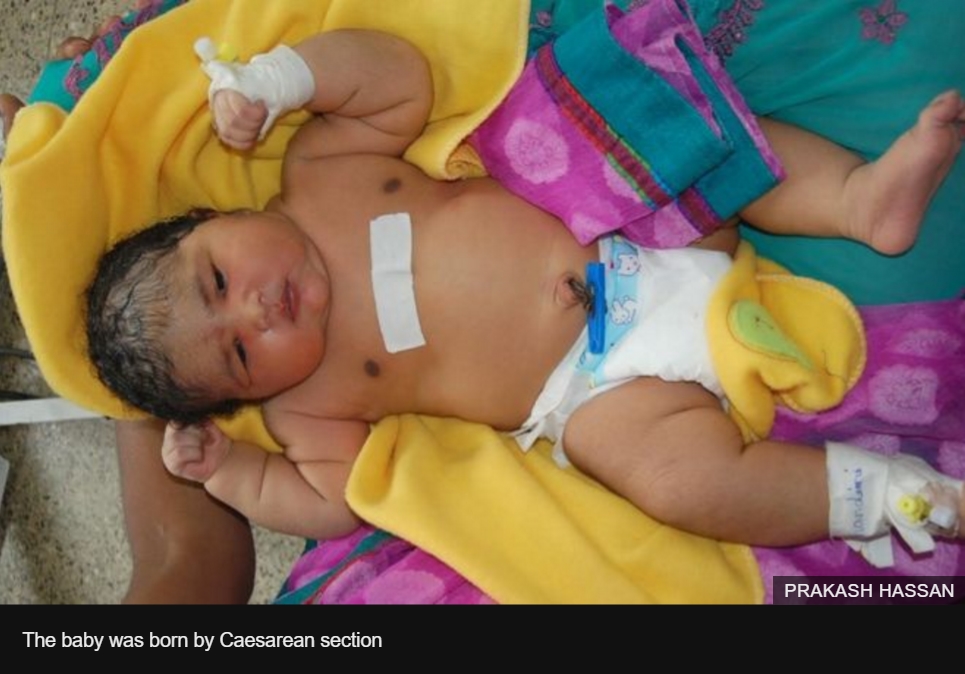 Elle a la taille et le poids d'un bébé de 6 mois, et pourtant : la photo de cette petite fille a été prise à sa naissance ! Copie d'écran de “BBC”, le 26 mai 2016.